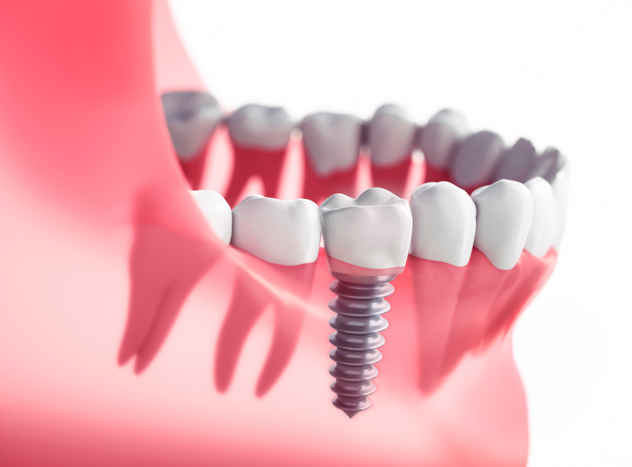 Closeup dental implant in the jaw